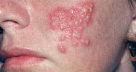 Below is a collection of herpes pictures that are in aim of showing you that not all herpes cases are severe and nasty. Estimated two-thirds of global population under 50 ...