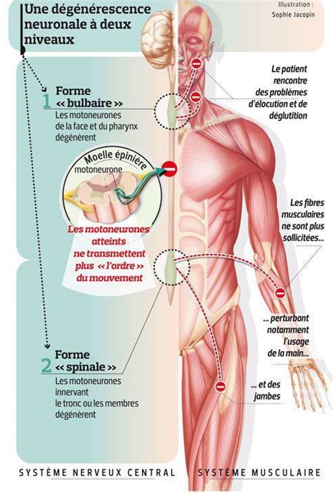 La maladie de crohn est une maladie inflammatoire chronique du système digestif. Sclérose latérale amyotrophique (maladie de charcot) - Qu ...