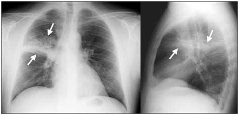 Assessment and plan • acute community acquired pneumococcal pneumonia: Community-acquired pneumonia | CMAJ
