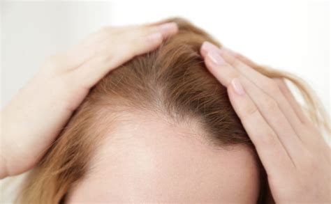 Are these disorders problems reversible? Thyroid and Hair Loss Thyroid and Hair Loss, hormones