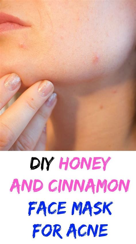 Honey face masks for curing acne using honey and salt. DIY Honey And Cinnamon Face Mask For Acne #acnemask ...