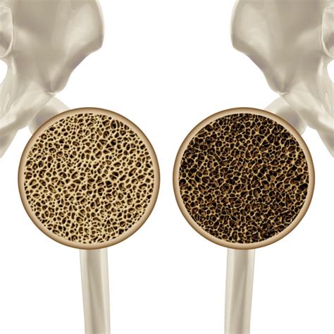 Fractures Resulting From Osteoporosis Double Risk of Death ...