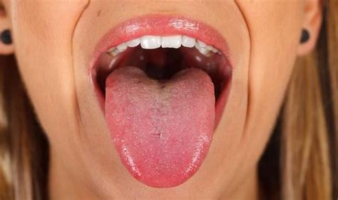 Seeing increasing numbers of covid tongues and strange mouth ulcers. You Can See More: Covid tongue: What is Covid tongue? ~ Health Tips