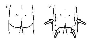 Women are now spending countless hours in the gym to work on their glutes. Limb Reconstruction (LR) : Physiotherapy Hip distractor ...