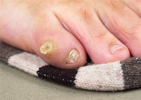 How to get rid of soft corn between toes.