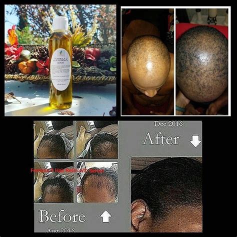 Proven formula to grow your hair with redensyl, anagain. Hair Oil Formula D Hair ReGrowth Serum For Fast Hair ...