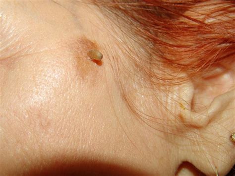 Healthool Cutaneous Horn - Pictures, Symptoms, Causes ...