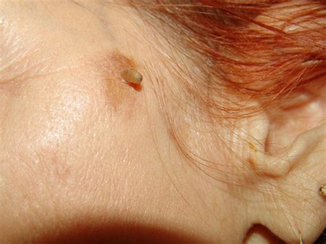 Cutaneous horns, also known by the latin name cornu cutaneum, are unusual keratinous skin tumors with the appearance of horns, or sometimes of wood or coral. Cutaneous Horn - Pictures, Symptoms, Causes, Removal ...