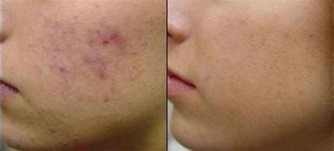 Stops eczema in just 24 hours. Home Remedies for Eczema Scars : Human N Health