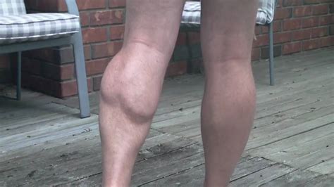 When i tore ligament in my knee. Calf muscle flexing - YouTube