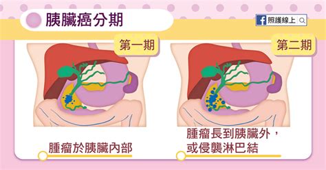 1 day ago · 根據 台灣癌症基金會 指出，胰臟位於後腹膜腔，早期胰臟癌沒有什麼症狀，若隨著腫瘤逐漸擴大，就會出現上腹痛、背痛、黃疸、體重減輕及下痢症狀。 常讓人束手無策的 - 胰臟癌（懶人包） - 照護線上