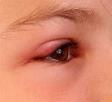 Acute is responsible for making your eyelids become swollen, itchy, and burning especially after exposure to a seasonal allergy that affects eyes. Swollen Eyelid - Symptoms, Treatment, Pictures, Causes ...