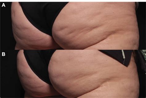 Plastic surgeon · beauty, cosmetic & personal care. Full text Cellulite: a review with a focus on subcision ...