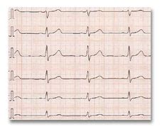 An electrocardiogram (ecg or ekg) records the electrical signal from your heart to check for different heart conditions. Praxis Dres. Drögemüller