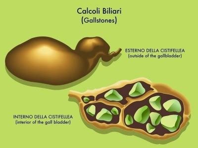 Latte, yogurt magro, ricotta e fiocchi di latte carne bianca magra Calcoli alla cistifellea o biliari, sintomi e intervento