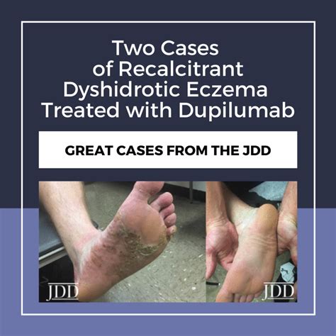 Vesicular palmoplantar eczema is a term used to describe a group of diseases characterized by vesiculobullous eruption involving mainly the hands and feet. JDD Corner - Next Steps in Dermatology