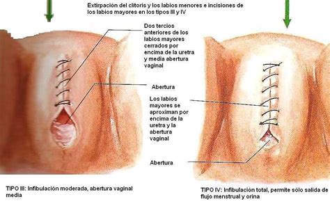 Labios mayores oscuros por cuando una mujer mantiene relaciones sexuales los labios genitales se llenan de sangre, lo que hace que aumenten de tamaño, se abran y, a causa de. Tipos De Labios Mayores - estilos de labios