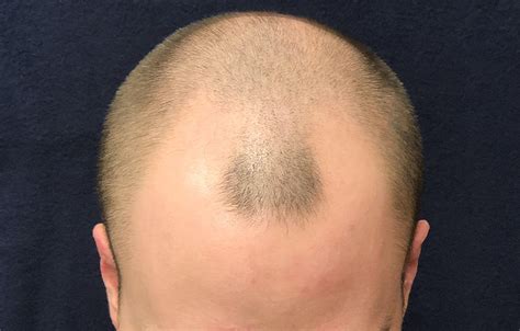 Since the scalp is moved forward, swelling and bruising are common after the. FUE Hair Transplant Case 707 - Ann Arbor Plastic Surgery