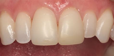 Direct composite veneers for esthetic reconstruction | Dental Economics