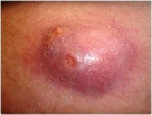 Learn the common symptoms, diagnosis and best treatment options for nodular acne in india. 7 nodular acne home treatment remedies that really work