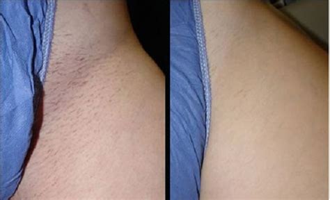 Electrolysis may be an option when hair. Laser Hair Removal - Bikini Line - Next Your Hub