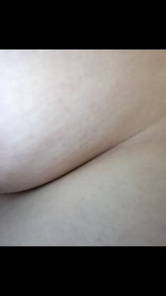 Associated signs and symptoms may include breast warmth, redness of the breast, and a swollen breast. Breast dimpling | Mumsnet Discussion