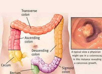 Hi walshmeister, my mother has just celebrated 5 years cancer free and is a colon cancer survivor. Know Your Colon Cancer - HEALTH