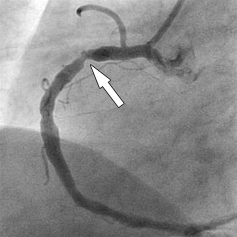 The medical name for this is a catheter angiogram. Coronary angiogram. Causes, symptoms, treatment Coronary ...