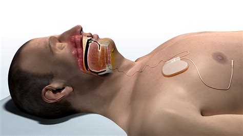 Answers to Your Questions About Inspire Upper Airway Stimulation ...