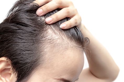 生え際が薄いと感じたら…薄毛チェックをしてみよう | 薄毛対策室
