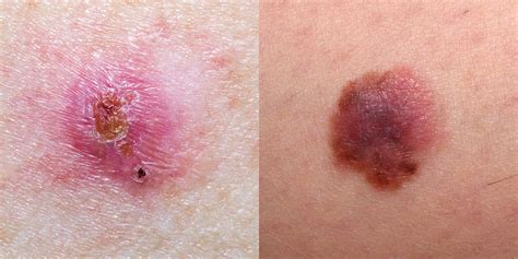 Early stage skin cancer may resemble a small spot or discolored blemish significantly smaller than the size of a fingernail. Skin Cancer Pictures - 5 Different Types of Skin Cancer to ...