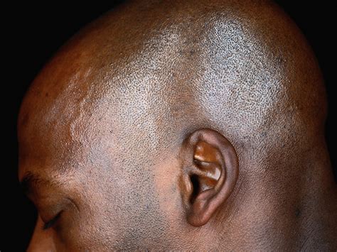 Before telling you how to stop headphones from crackling, let us briefly tell you about the possible causes. Crackling in Ear: Causes, Symptoms, Remedies, Treatment