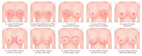 If breast size can differ, then why not the shape of breasts? Researchers explore limitations of patient-specific, 3D ...