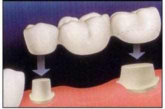 Bukan hanya karena faktor estetis, gigi tiruan juga perlu. Mengenal Jenis-jenis Gigi Palsu Gigi Tiruan | Cara Membuat ...