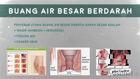 Masalah konstipasi yang terlambat ditangani bisa menyebabkan obstruksi usus. Buang Air Besar Berdarah - YouTube