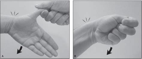 Finkelstein's test finkelstein's test is used to diagnose dequervain's tenosynovitis in people who to perform the test, the thumb is placed in the closed fist and the hand is ulnar deviated, as shown in. Finkelstein Test • LITFL • Medical Eponym Library