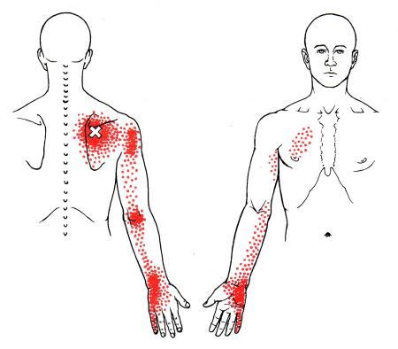 Common characteristics of shoulder blade pain. Serratus Posterior Superior | The Trigger Point & Referred ...