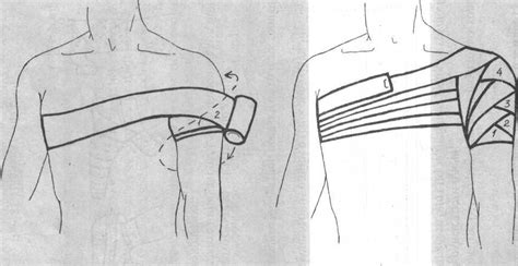Виды повязок и правила их наложения. Колосовидная повязка на плечевой сустав: алгоритм, видео