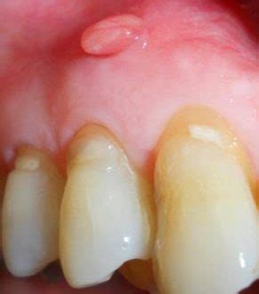 A dental abscess, also known as a gum boil, occurs when the nerve and blood vessel in the centre of a tooth becomes infected. Gum Boil, Abscess, Causes, Meaning, Pictures, Symptoms, No ...