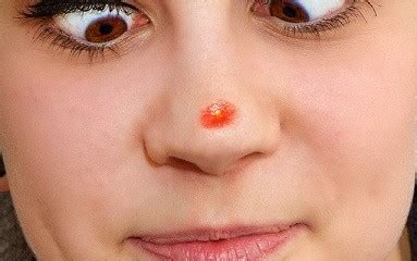 It may also grow sideways beneath the skin. Nose Pimple - How To Remove? | Styles At Life