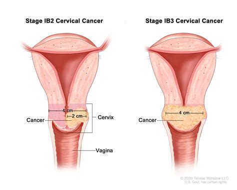 Cervical cancer is not considered to be on the rise, due to advances in medical screening technology and treatment. Cervical Cancer Treatment (PDQ®)-Health Professional ...