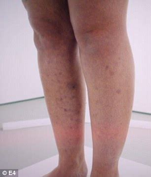 Most ingrown hairs on the legs do not cause complications, and they usually resolve on their own. Body Fixers's Amelia refuses to let her boyfriend see her ...