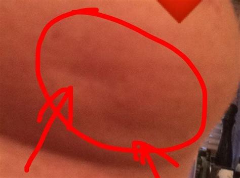 Dimpling — which can make the skin resemble the skin of an orange peel — is a concerning sign. Breast cancer patient Lisa Royle posts photo of 'subtle ...