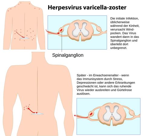 Der mit abstand häufigste erreger (90 % bis 95 % der fälle) ist legionella pneumophila (vor allem der serotyp 1). Windpocken Symptome Die typischen Symptome der Kinderkrankheit