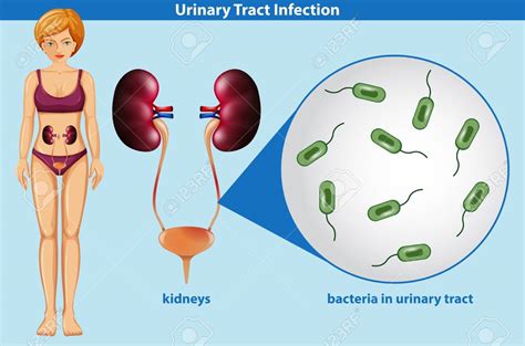 Les signes d'une infection urinaire incluent une envie fréquente d'aller uriner, des brûlures, des démangeaisons, des. Infections urinaires chez l'adulte - NEPHROHUG