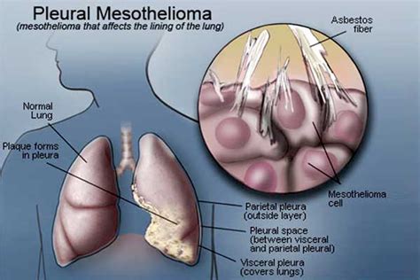 Malignant mesothelioma treatment may include surgery, radiation therapy, and chemotherapy. Mesothelioma - Sistem Staging - Ikhtisar - Infinite JLB