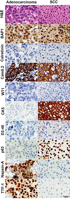 Bap1 ihc is a prognostic test in uveal melanoma. Oncotarget | Positive nuclear BAP1 immunostaining helps ...