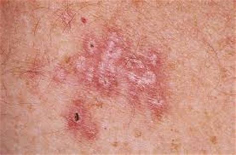 This usually causes oral sores. Genital Warts | India| PDF | PPT| Case Reports | Symptoms ...