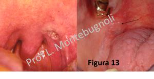 It is the part of respiratory systems. Inverted papilloma nasal cavity histology Papilloma nasal ...