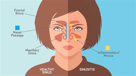 Memberikannya tempat berteduh yang layak. Kerap Bersin, Hidung Tersumbat, Mata Berair & Ada ...